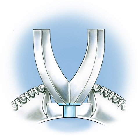 Evaluate the quality of a platinum ring mounting after its peg setting is replaced with another using these helpful illustrations and instructional video