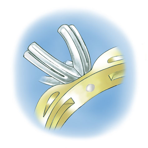 Learn how to evaluate the quality of a platinum ruthenium peg setting installation into a 14K yellow gold mounting with these helpful illustrations and instructional video Learn how to evaluate the quality of a platinum ruthenium peg setting installation into a 14K yellow gold mounting with these helpful illustrations and instructional video