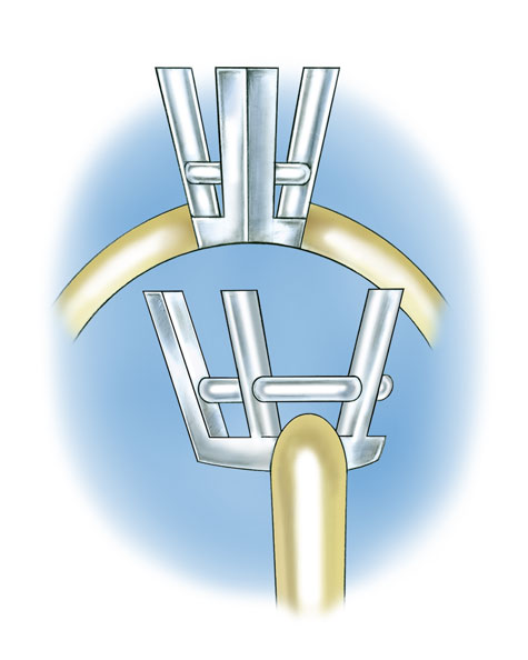 Four-prong, pear-shaped platinum cobalt setting with 14K yellow gold shank Four-prong, pear-shaped platinum cobalt setting with 14K yellow gold shank