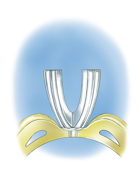 Learn how to evaluate the quality of a platinum ruthenium peg setting installation into a 14K yellow gold mounting with these helpful illustrations and instructional video Learn how to evaluate the quality of a platinum ruthenium peg setting installation into a 14K yellow gold mounting with these helpful illustrations and instructional video