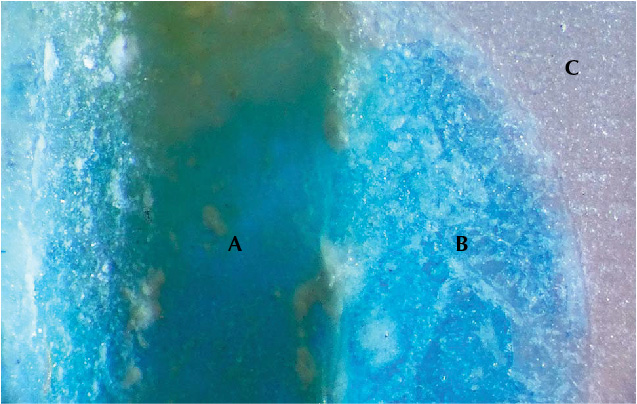 Drill hole, epoxy filling, and colorless chalcedony revealed when bead is cross sectioned.