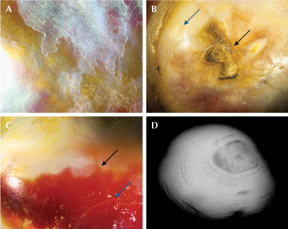Figure 2. A: Nacreous platy structure on the top portion of the pearl. B: Nacreous structure (blue arrow) and non-nacreous structure (black arrow). C: Surface-reaching cracks (blue arrow) and boundary between two colored portions of the non-nacreous surface (black arrow). D: RTX image showing the organic-rich concentric natural growth pattern following the shape of the pearl. Photomicrographs by Lubna Sahani; fields of view: 0.80 mm (A), 2.20 mm (B), and 1.5 mm (C).