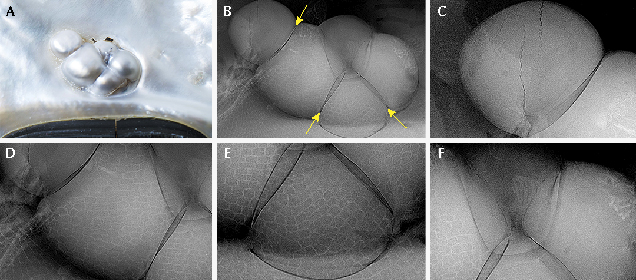 Microradiographs reveal clear boundaries in this aggregate blister pearl.