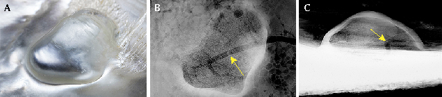 Partially merging outline typical of shell blisters.