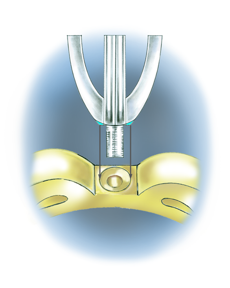 Learn how to evaluate the quality of a platinum ruthenium peg setting installation into a 14K yellow gold mounting with these helpful illustrations and instructional video