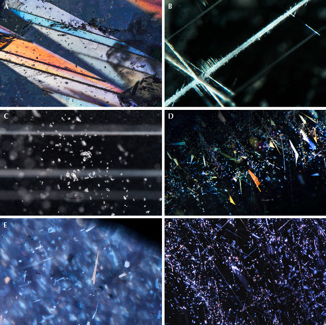 Figure 35. Typical inclusions in Umba sapphires. A: Multiple twinned sectors in cross-polarized light. B: Secondary aluminum oxy-hydroxide minerals formed in the intersection of twins. C: Clusters of zircon inclusions. D: Platelet-like reflective particles with iridescent thin-film interference colors using fiber-optic illumination. E: Platelet inclusions. F: Silk in an Umba sapphire, from elongate needles to platelet-like inclusions. Photomicrographs by Aaron Palke (A, B, D, and F), Charuwan Khowpong (C), and Ungkhana Atikarnsakul (E); fields of view 3.57 mm (A), 1.42 mm (B), 2.90 mm (C), 2.34 mm (D), 4.64 mm (E), and 2.90 mm (F).