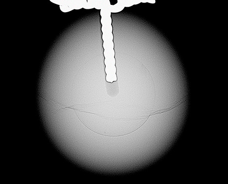 Figure 3. RTX image of a bead cultured pearl reference sample with a metal post in the drill hole. The metal appears radiopaque and matches the appearance of the core feature in the pearl examined in the present study.