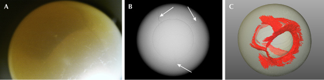 Figure 3. A: A South Sea bead cultured pearl displaying multiple “tideline” features under the surface. Photomicrograph by Emiko Yazawa; field of view 14.52 mm. B: X-ray microradiograph of the pearl showing the cracks (indicated by arrows) extending from the bead nucleus toward the surface. C: 3D reconstruction using X-ray computed microtomography data generated an overall 3D representation of the distribution of the internal cracks (in red).