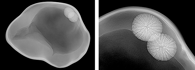 Figure 2. Real-time microradiographs showing the overall internal structure of the pearl (left) and greater detail of the foreign materials (right).