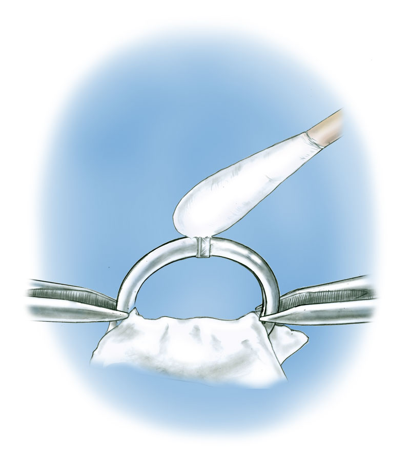 Learn how to evaluate the quality of a semi-finished assembled ring made from platinum cobalt components with these helpful illustrations and instructional video